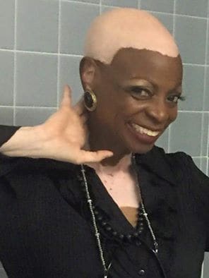 Black woman with vitiligo