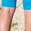 Camouflage Makeup Spray covers Varicose Veins