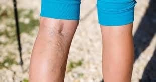 Camouflage Makeup Spray covers Varicose Veins