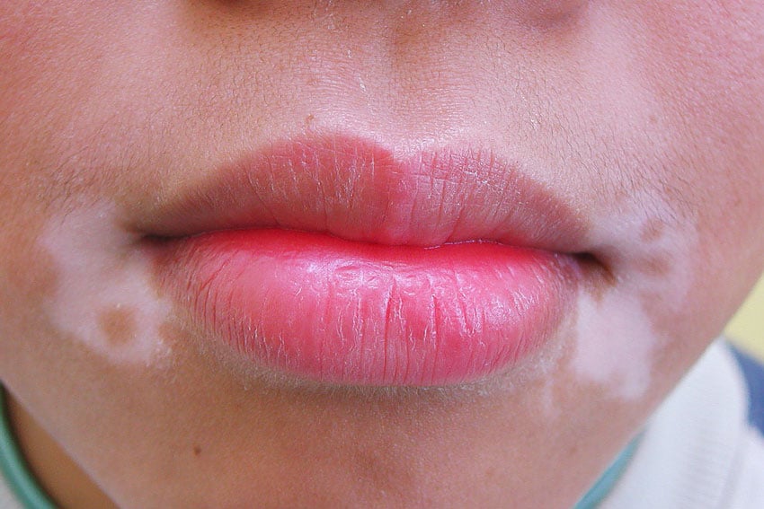 Vitiligo on Mouth