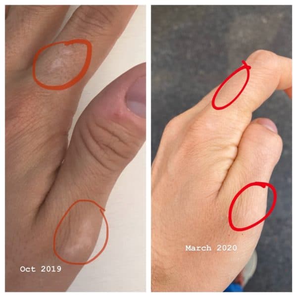 GShaffer-before-after-vitiligo-photo