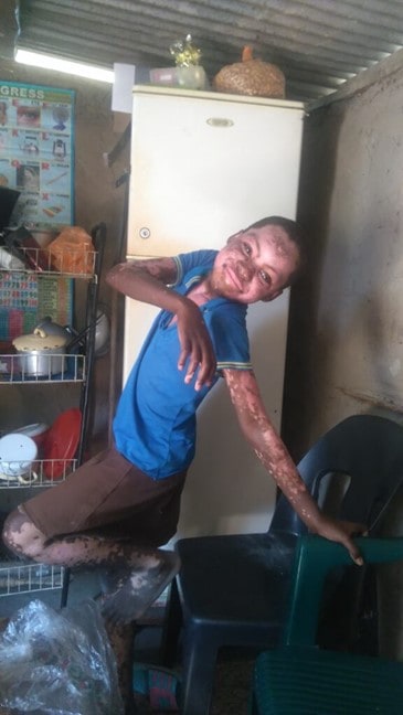 Faith from Zambia acquired vitiligo
